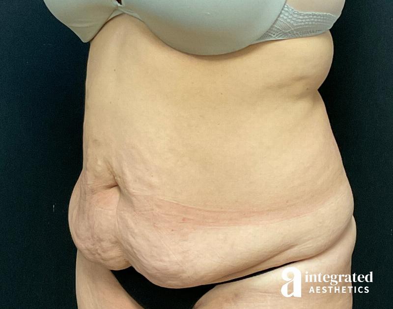 Tummy Tuck Before & After Gallery - Patient 133213534 - Image 3