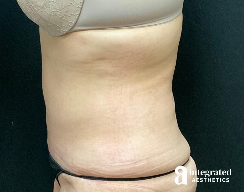 Tummy Tuck Before & After Gallery - Patient 133213534 - Image 6