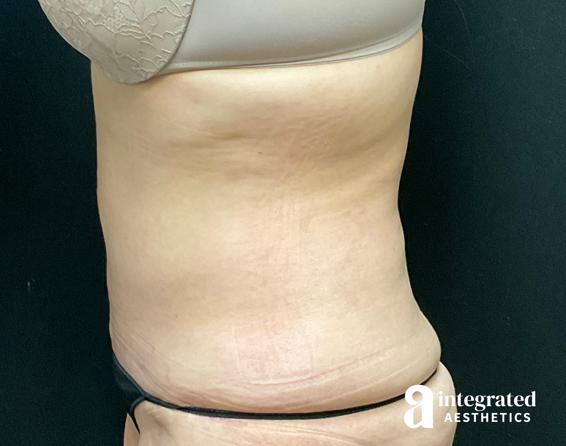 Tummy Tuck Before & After Gallery - Patient 133213534 - Image 6