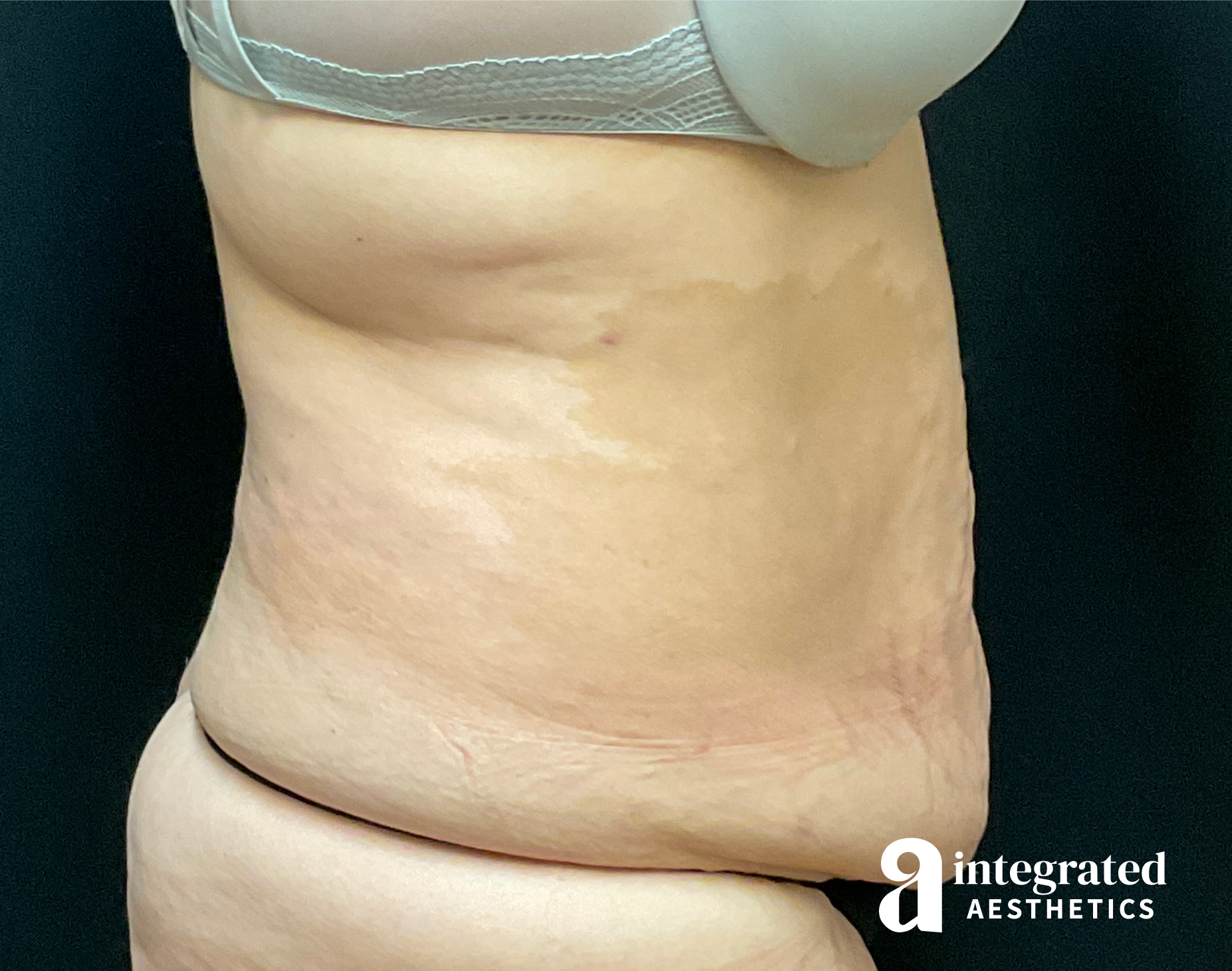 Tummy Tuck Before & After Gallery - Patient 133213534 - Image 7