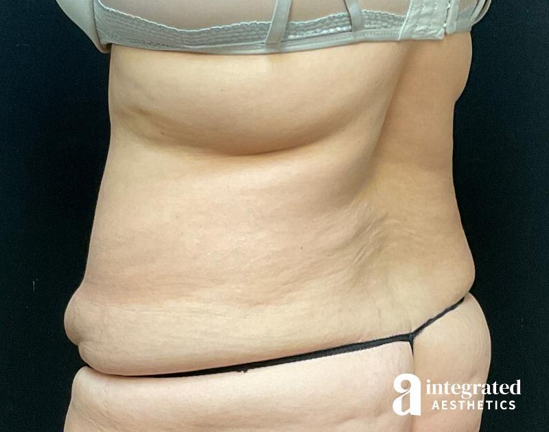 Tummy Tuck Before & After Gallery - Patient 133213534 - Image 9