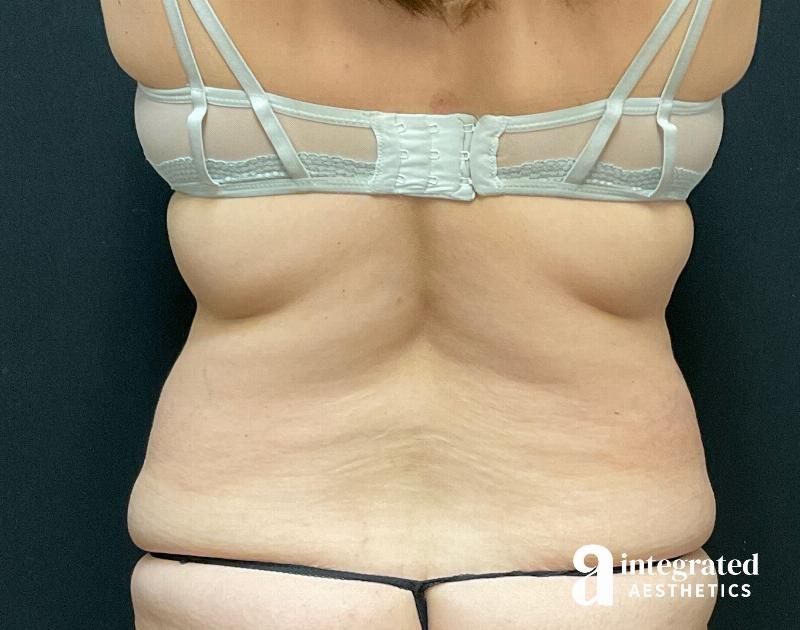 Tummy Tuck Before & After Gallery - Patient 133213534 - Image 11