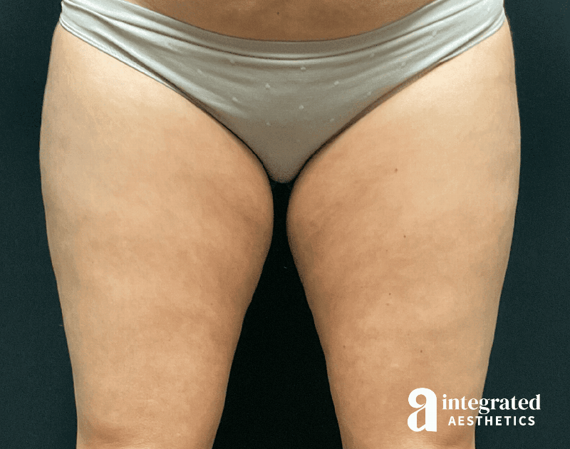 BodyTite Before & After Gallery - Patient 133213670 - Image 11