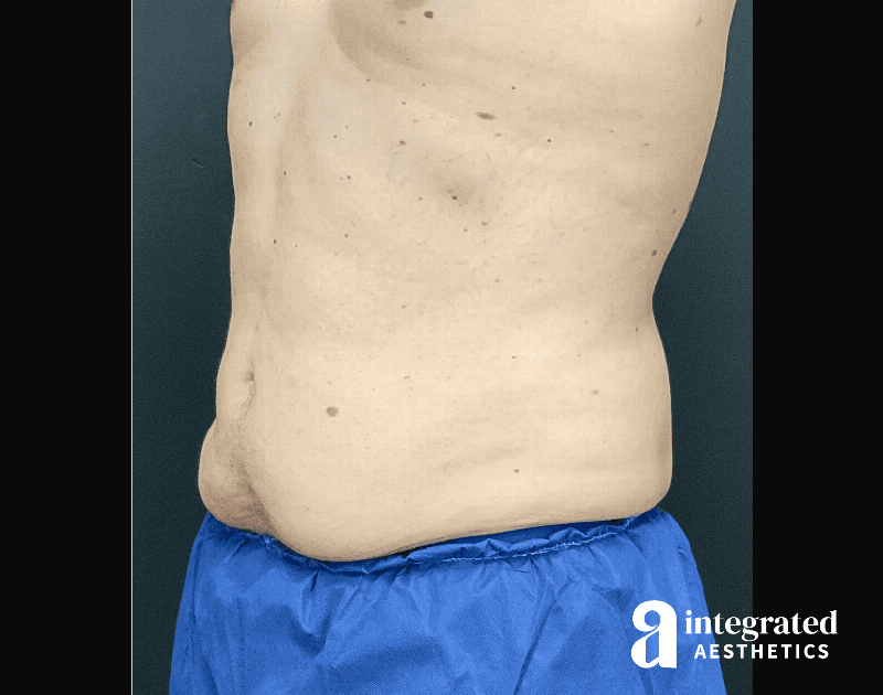 BodyTite Before & After Gallery - Patient 133213690 - Image 4