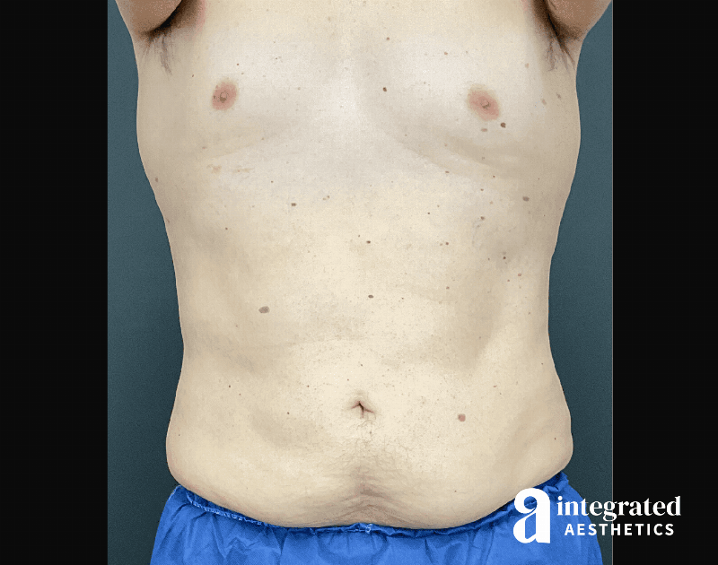 BodyTite Before & After Gallery - Patient 133213690 - Image 2