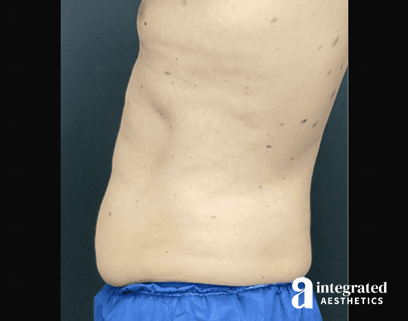 BodyTite Before & After Gallery - Patient 133213690 - Image 8