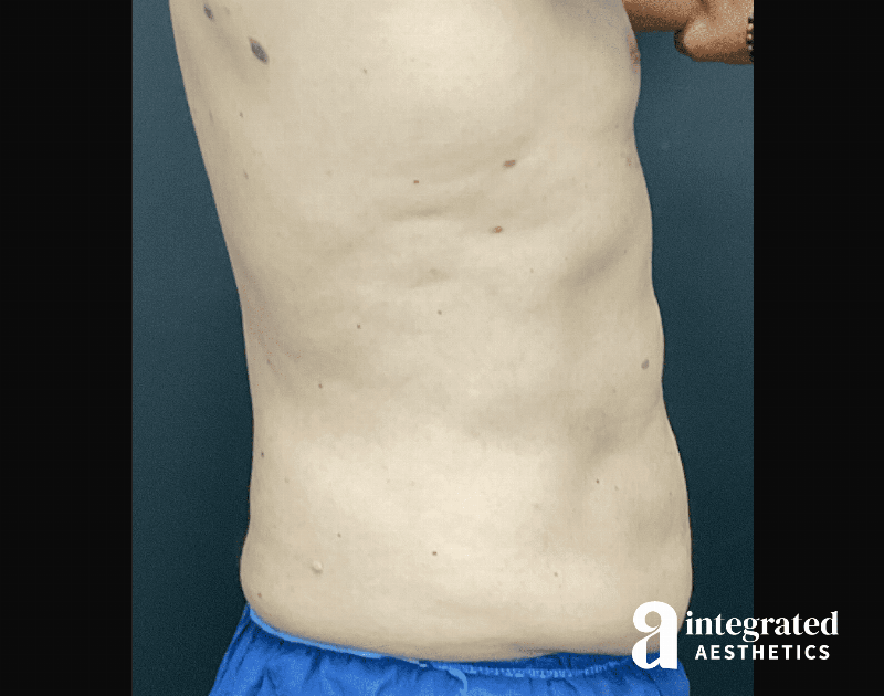 BodyTite Before & After Gallery - Patient 133213690 - Image 10