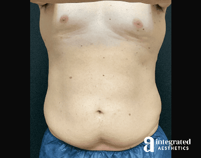 BodyTite Before & After Gallery - Patient 133213690 - Image 1