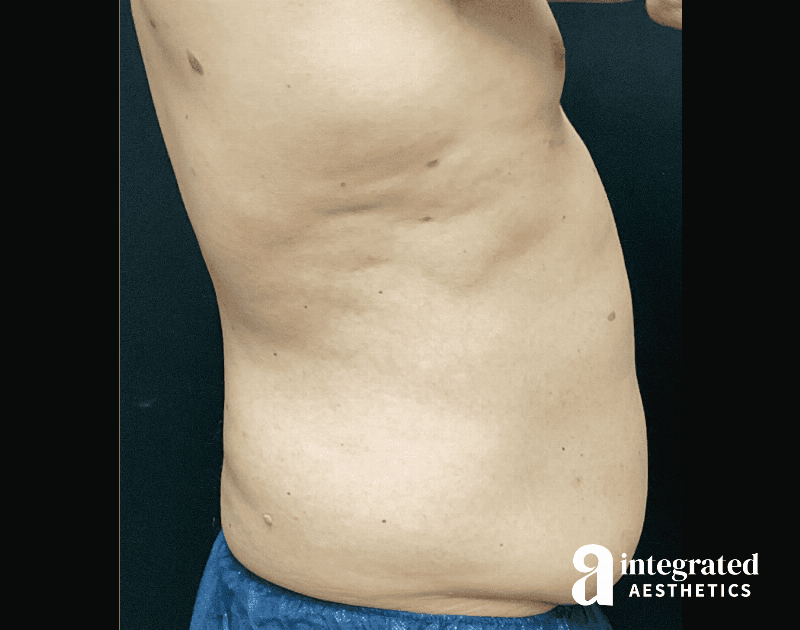 BodyTite Before & After Gallery - Patient 133213690 - Image 9