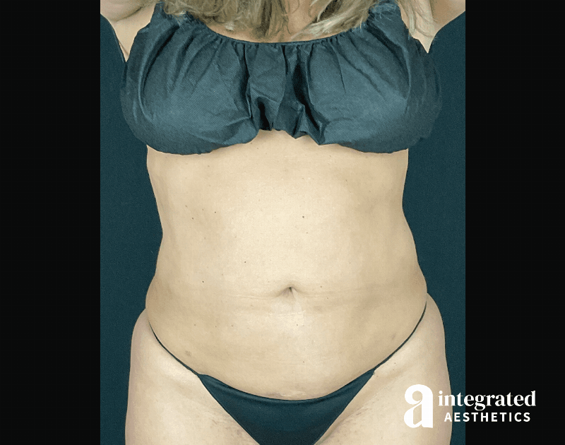 BodyTite Before & After Gallery - Patient 133213784 - Image 2