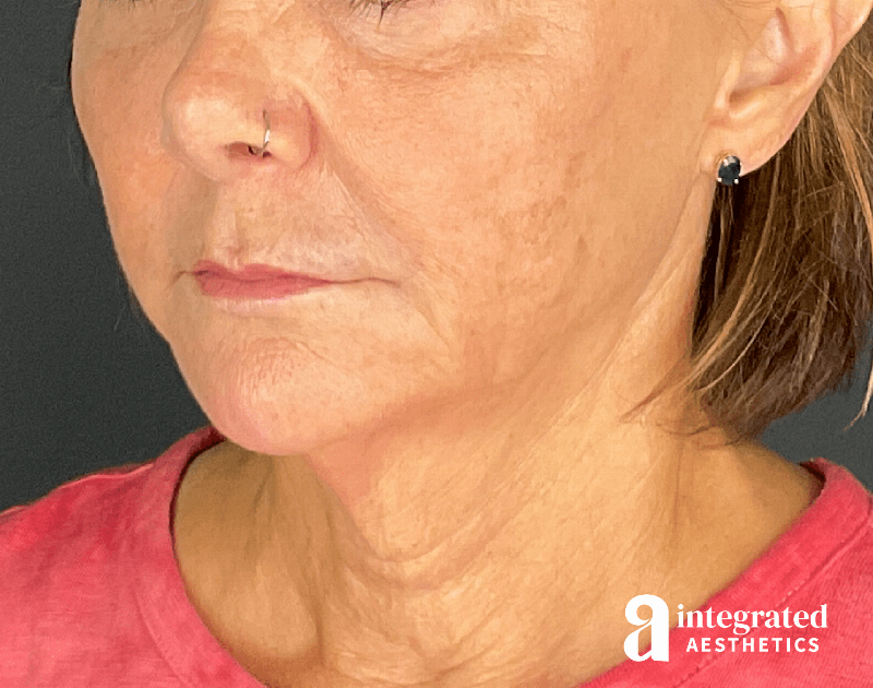 Sculptra Before & After Gallery - Patient 148564291 - Image 8