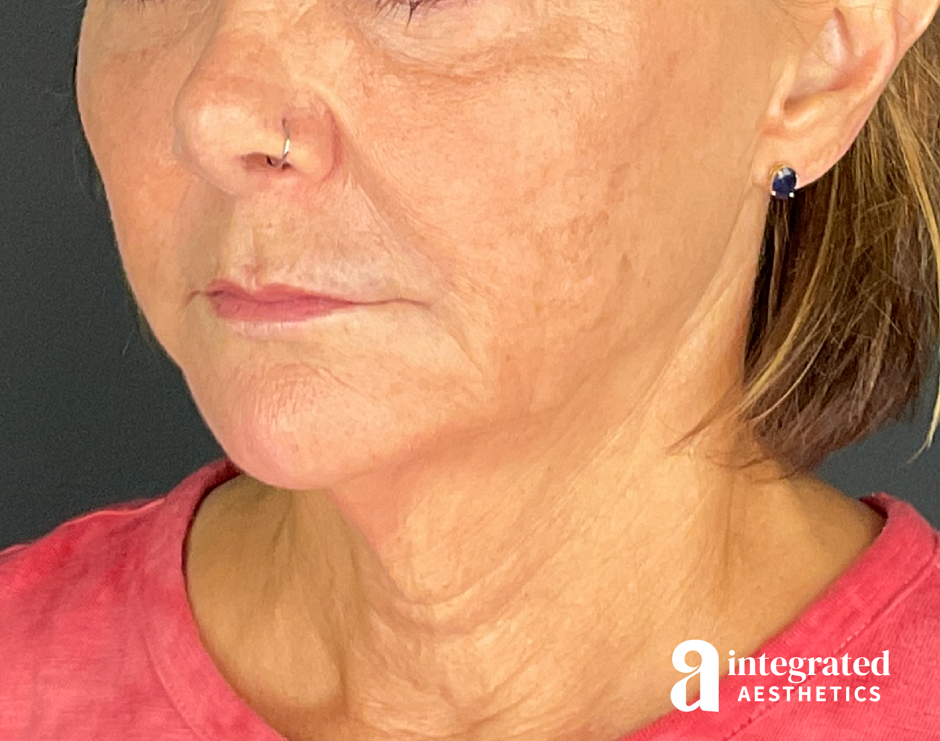 Lip Filler Before & After Gallery - Patient 148574556 - Image 8