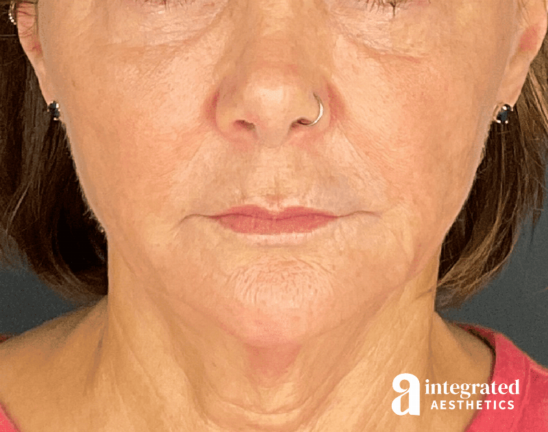 Sculptra Before & After Gallery - Patient 148564291 - Image 2