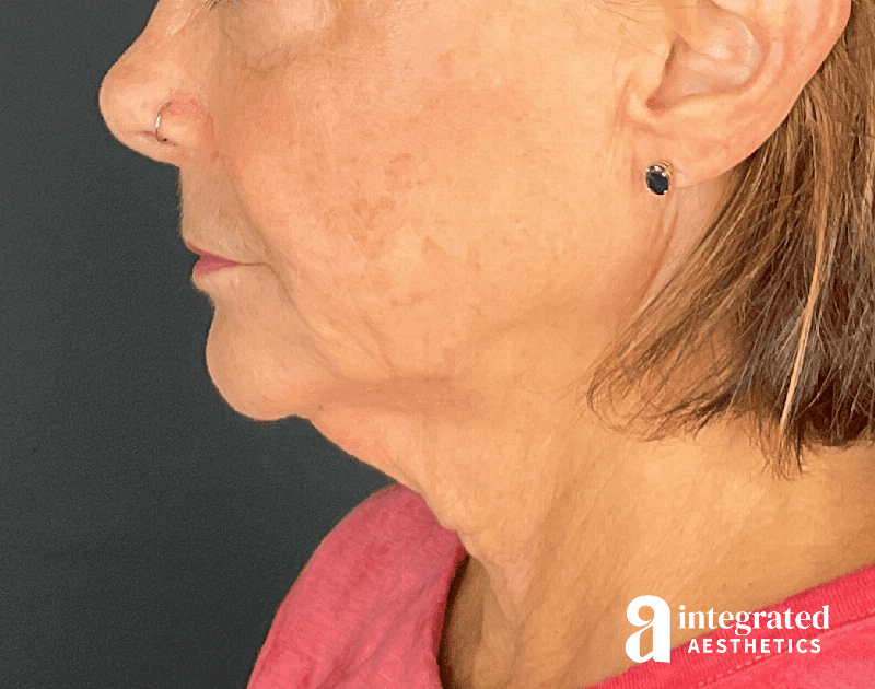 Sculptra Before & After Gallery - Patient 148564291 - Image 10