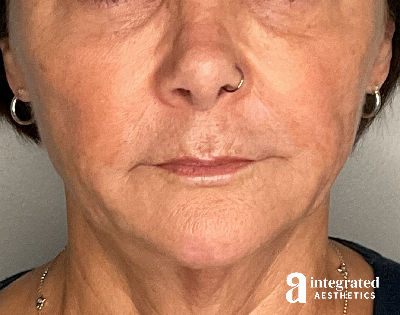 Dermal Fillers Before & After Gallery - Patient 148573831 - Image 1