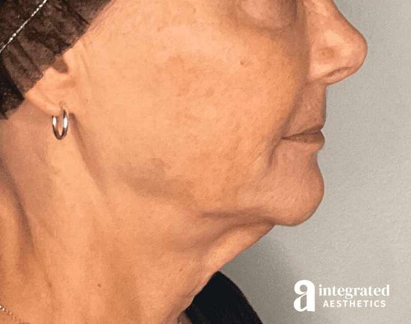 Sculptra Before & After Gallery - Patient 148564291 - Image 5