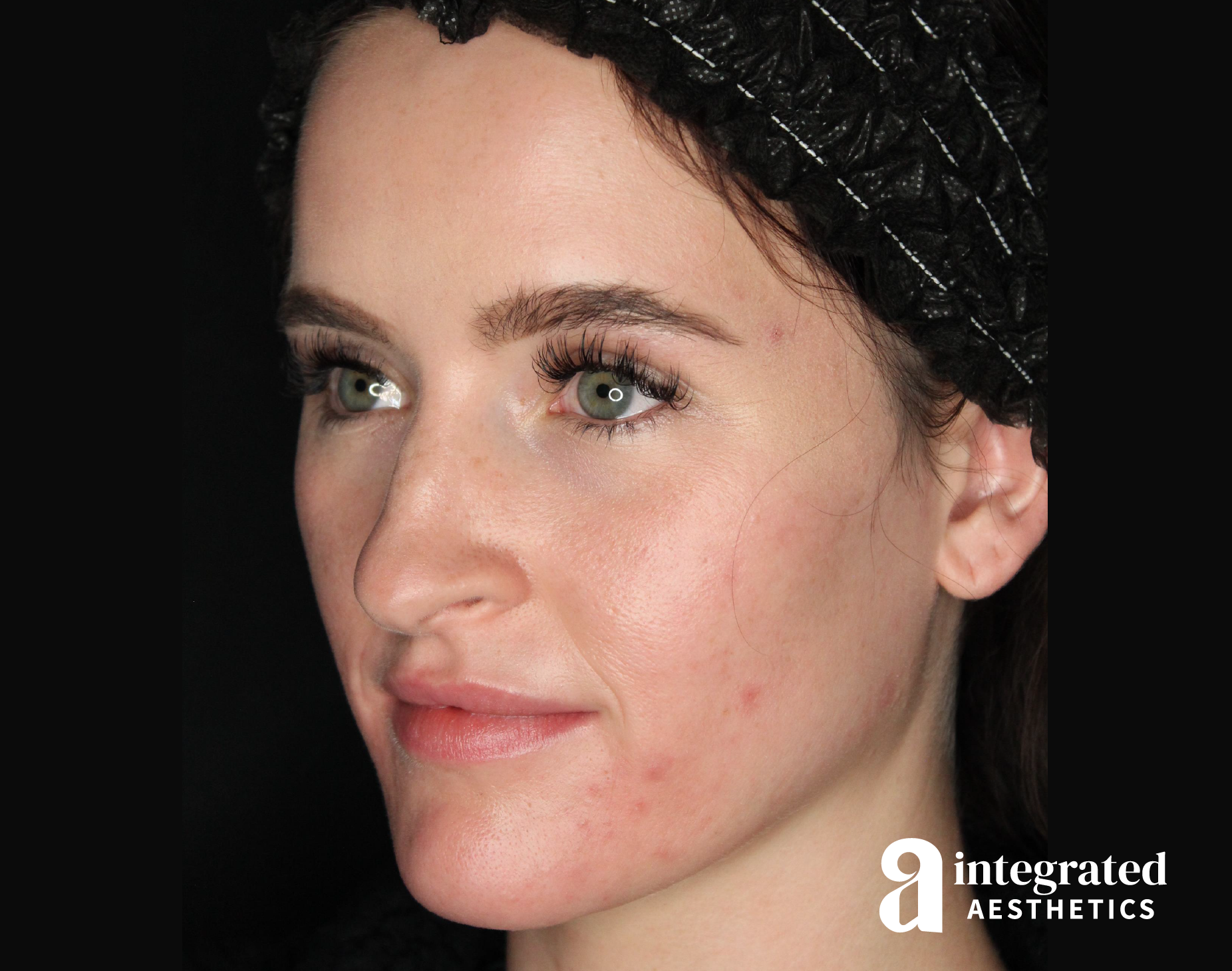 Sculptra Before & After Gallery - Patient 148564567 - Image 1