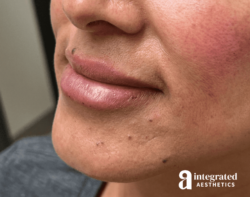 Dermal Fillers Before & After Gallery - Patient 148573676 - Image 6