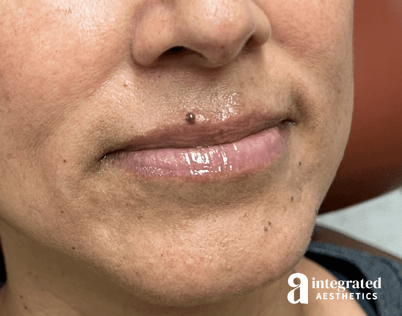 Dermal Fillers Before & After Gallery - Patient 148573676 - Image 3