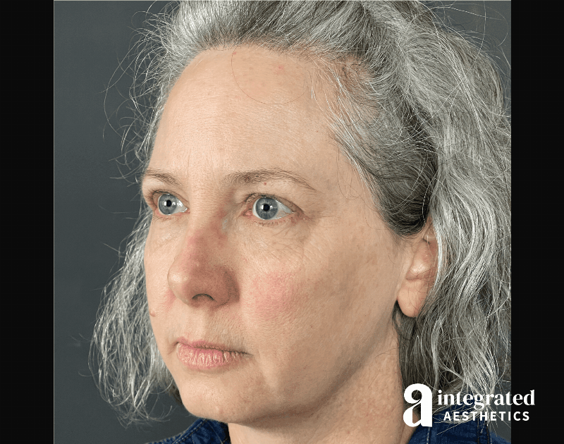 Wrinkle Relaxers Before & After Gallery - Patient 148574305 - Image 10