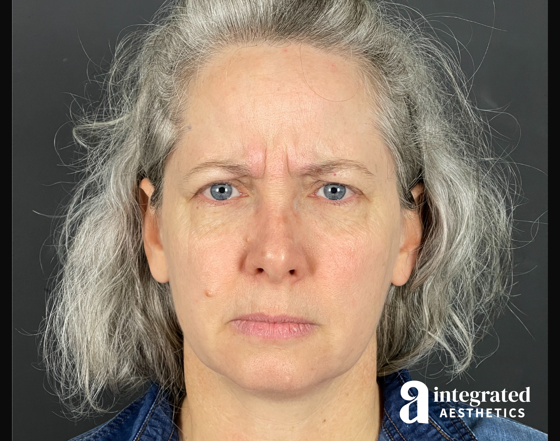 Wrinkle Relaxers Before & After Gallery - Patient 148574305 - Image 4