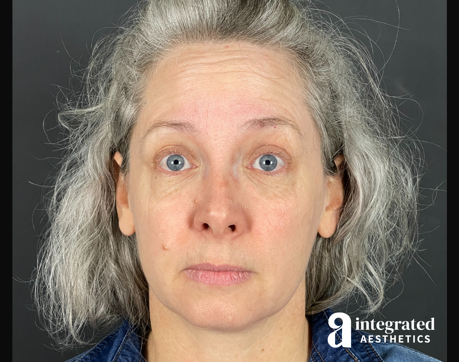 Wrinkle Relaxers Before & After Gallery - Patient 148574305 - Image 6