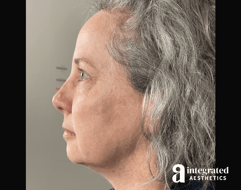 Wrinkle Relaxers Before & After Gallery - Patient 148574305 - Image 16