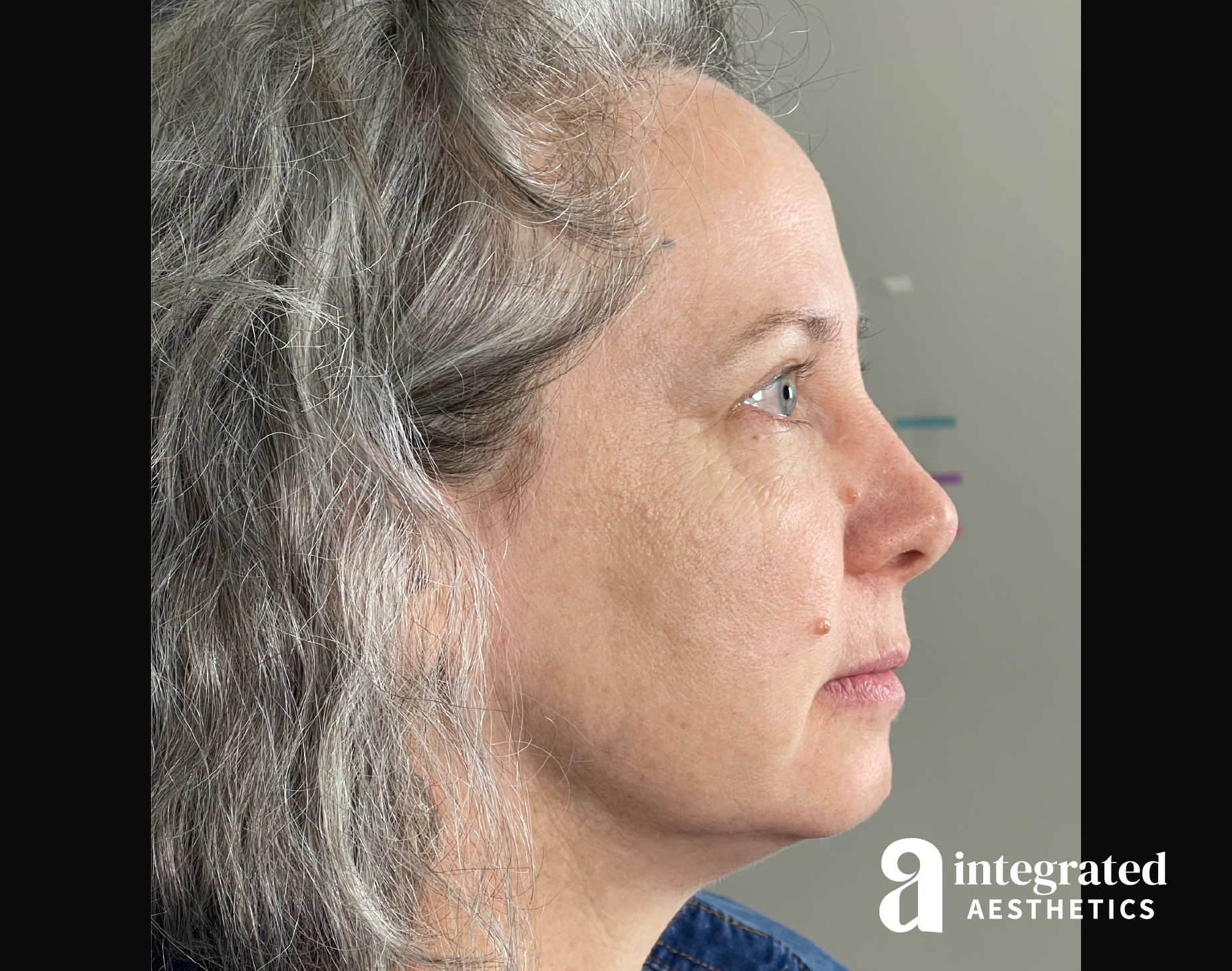 Wrinkle Relaxers Before & After Gallery - Patient 148574305 - Image 18