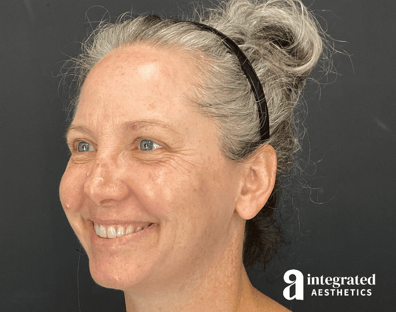 Wrinkle Relaxers Before & After Gallery - Patient 148574305 - Image 11