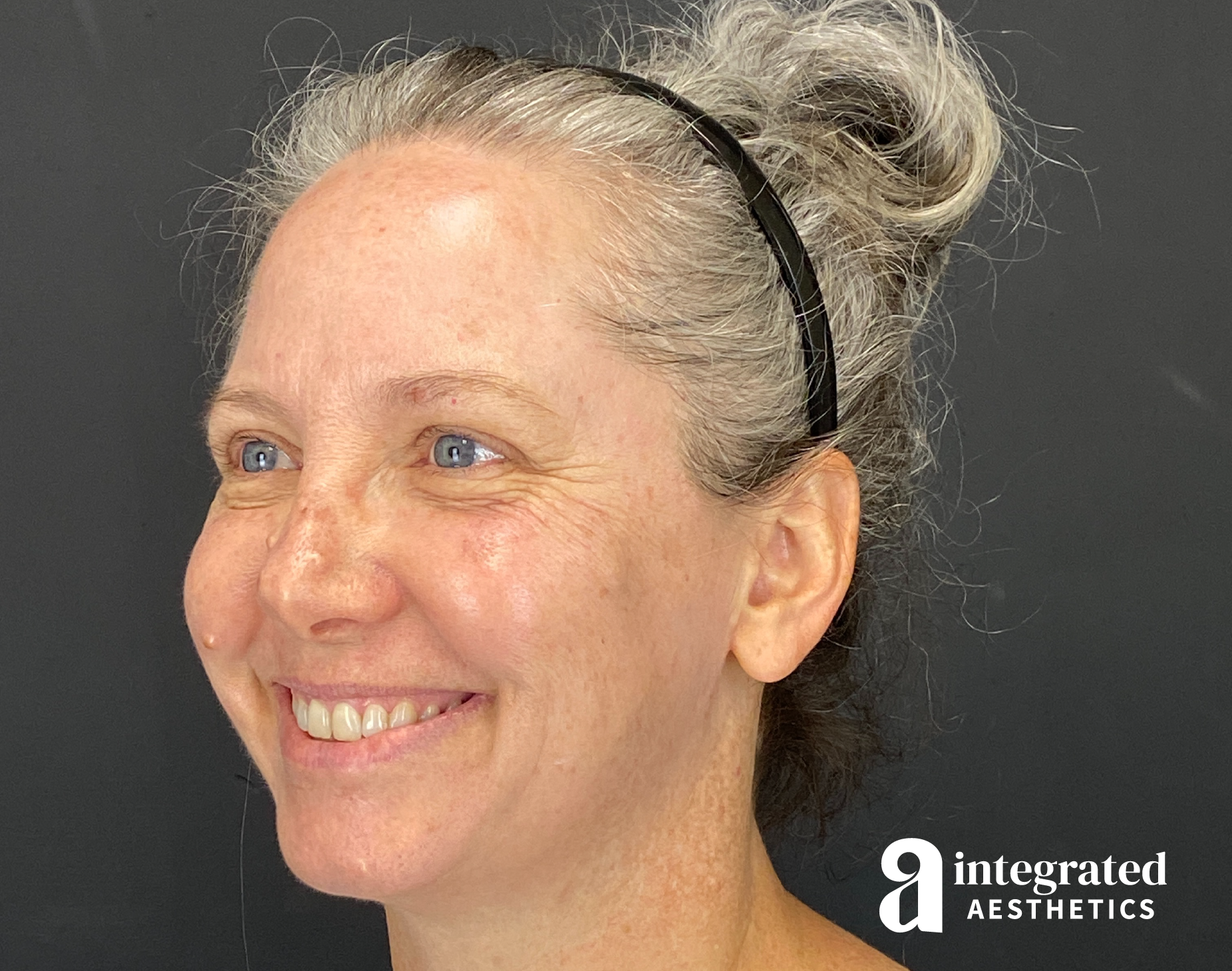 Wrinkle Relaxers Before & After Gallery - Patient 148574305 - Image 11