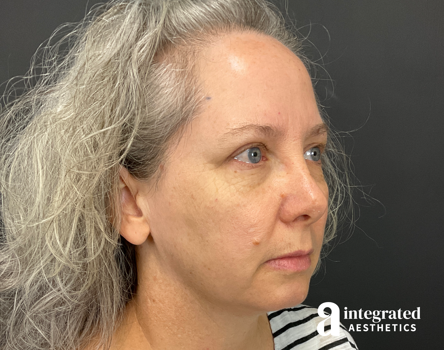 Wrinkle Relaxers Before & After Gallery - Patient 148574305 - Image 13