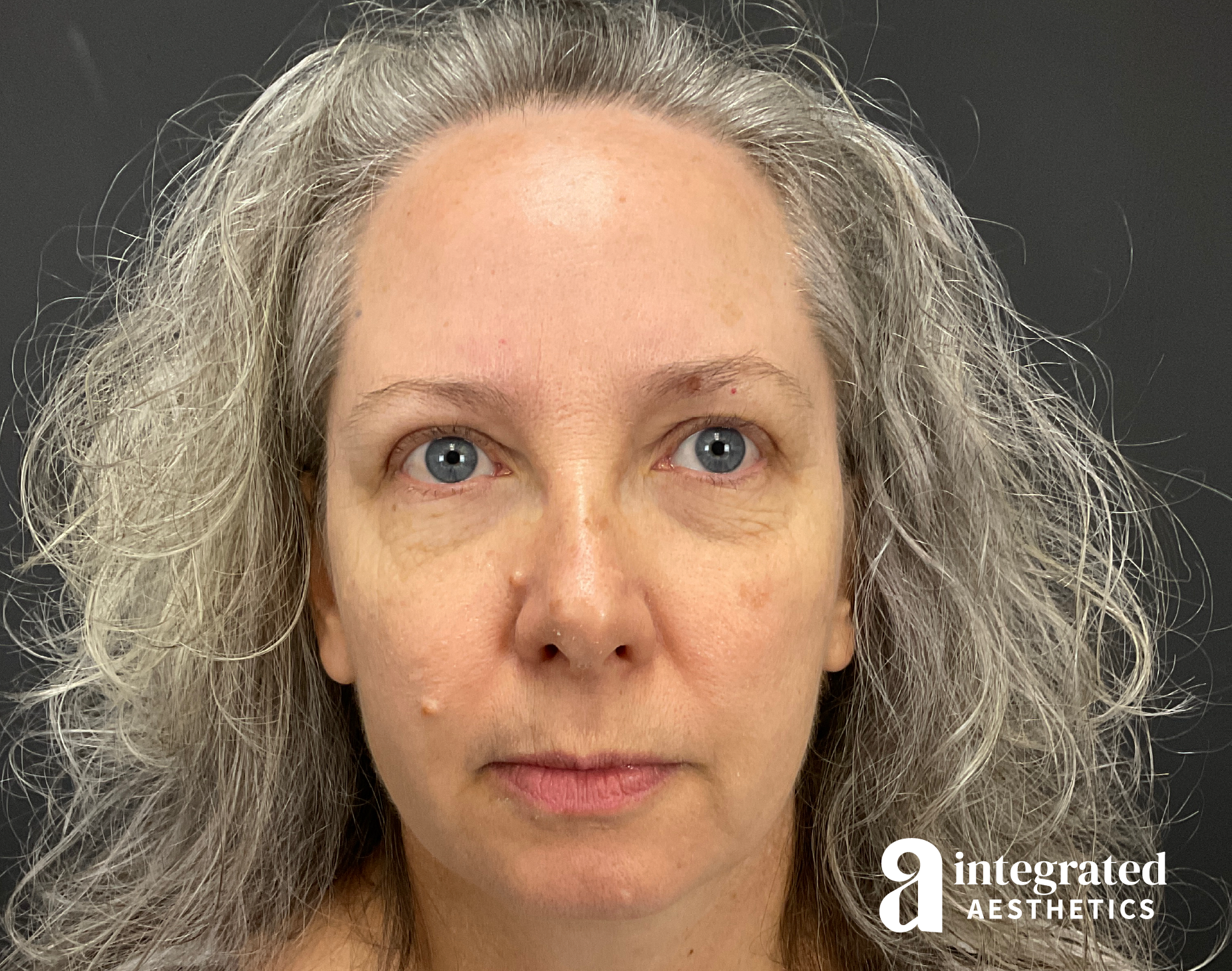 Wrinkle Relaxers Before & After Gallery - Patient 148574305 - Image 1