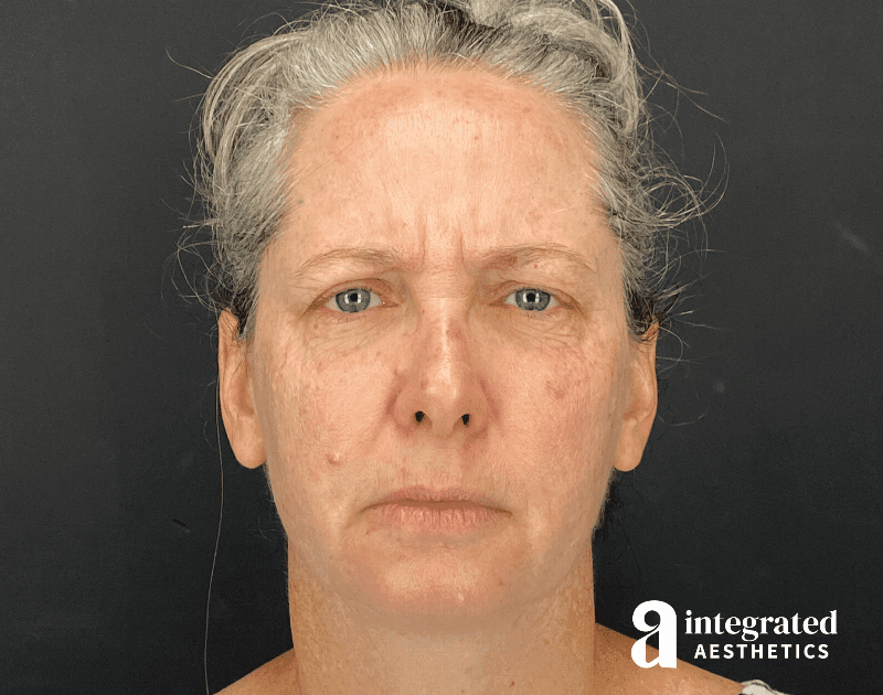 Wrinkle Relaxers Before & After Gallery - Patient 148574305 - Image 3