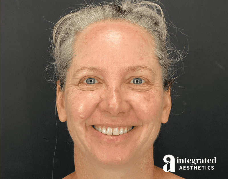 Wrinkle Relaxers Before & After Gallery - Patient 148574305 - Image 7