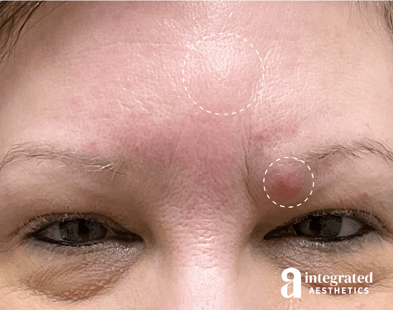 Cysts/Lipomas Before & After Gallery - Patient 157150409 - Image 1