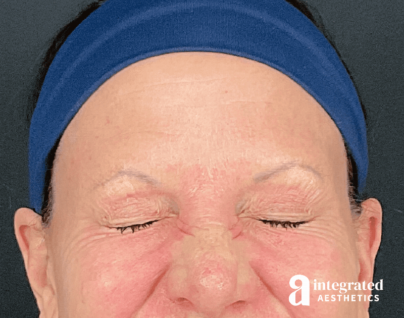 Wrinkle Relaxers Before & After Gallery - Patient 157150676 - Image 4