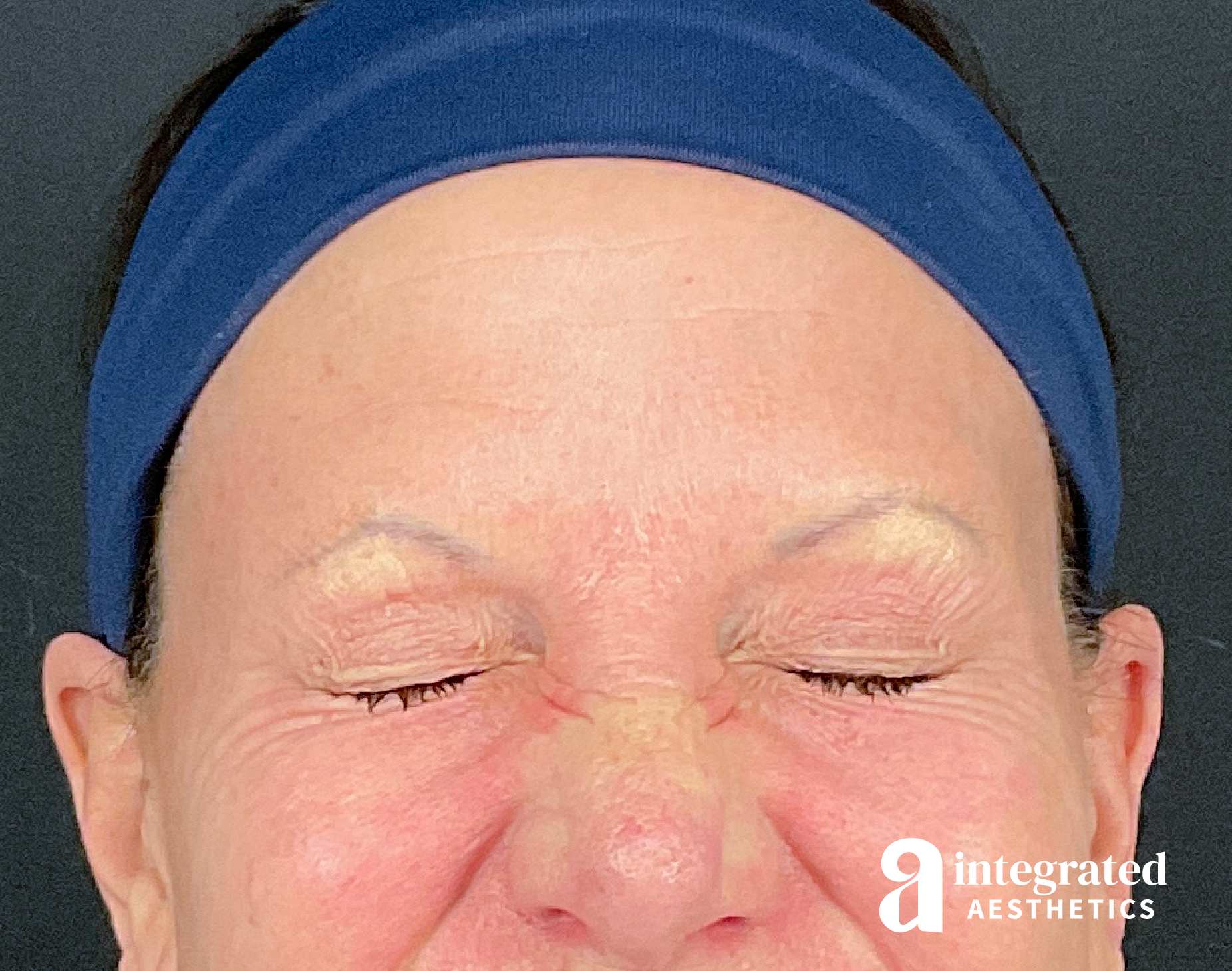 Dermal Fillers Before & After Gallery - Patient 157150693 - Image 4