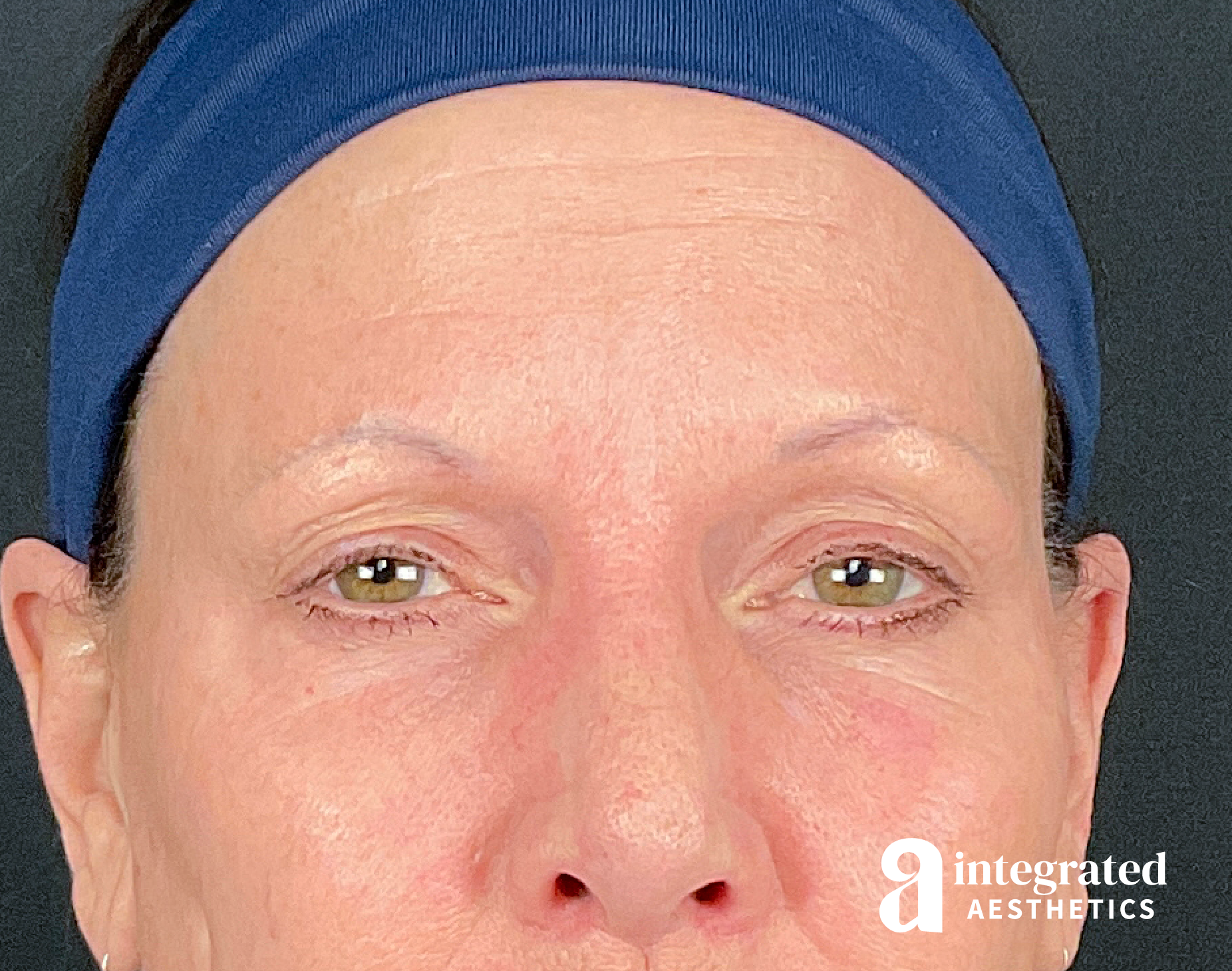 Dermal Fillers Before & After Gallery - Patient 157150693 - Image 2