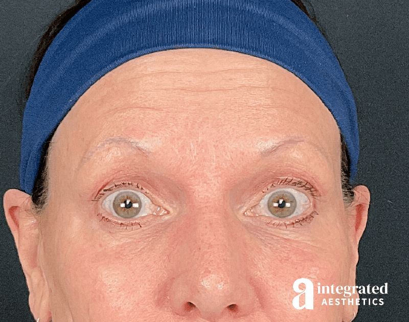 Wrinkle Relaxers Before & After Gallery - Patient 157150676 - Image 8