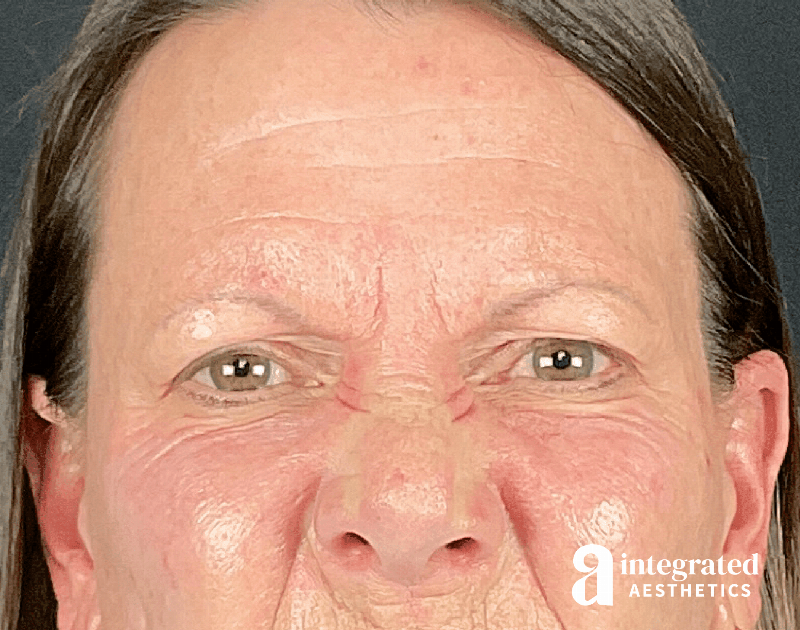 Wrinkle Relaxers Before & After Gallery - Patient 157150676 - Image 5