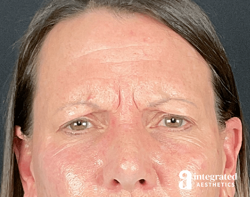 Wrinkle Relaxers Before & After Gallery - Patient 157150676 - Image 1