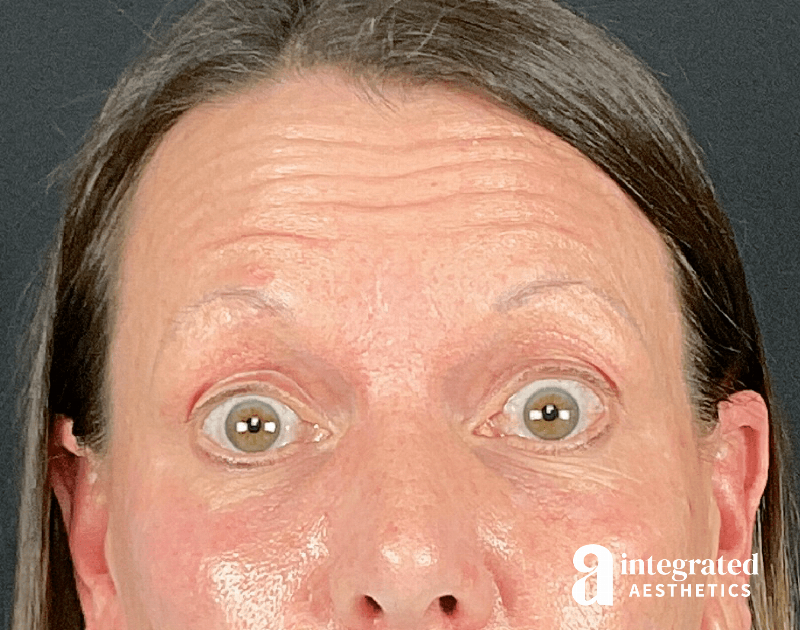 Wrinkle Relaxers Before & After Gallery - Patient 157150676 - Image 7