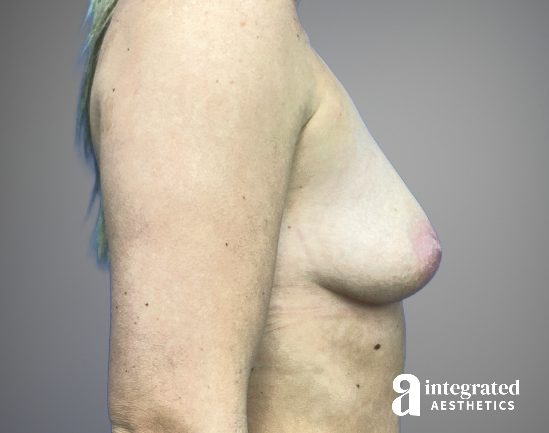 Breast Augmentation Before & After Gallery - Patient 232509 - Image 5