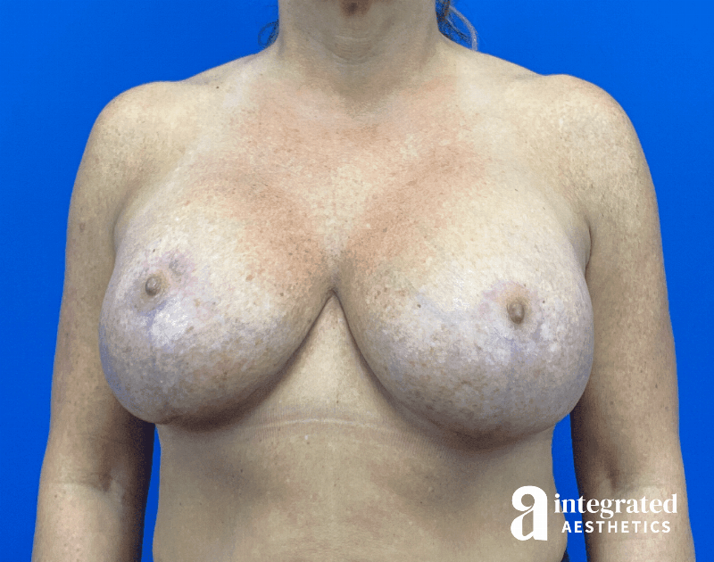 Breast Augmentation Before & After Gallery - Patient 281419 - Image 2