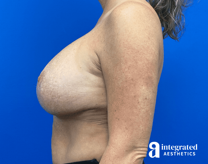 Breast Augmentation Before & After Gallery - Patient 281419 - Image 10