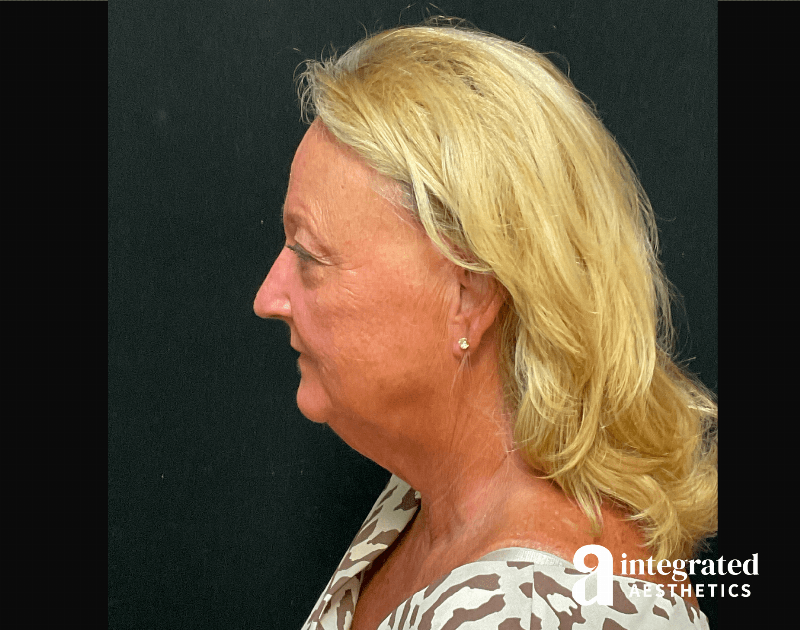 Facelift & Neck Lift Before & After Gallery - Patient 194392 - Image 9