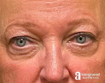 Blepharoplasty Before & After Gallery - Patient 218491 - Image 1