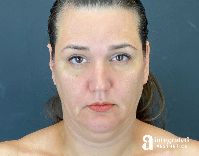 Facelift & Neck Lift Before & After Gallery - Patient 614844 - Image 1