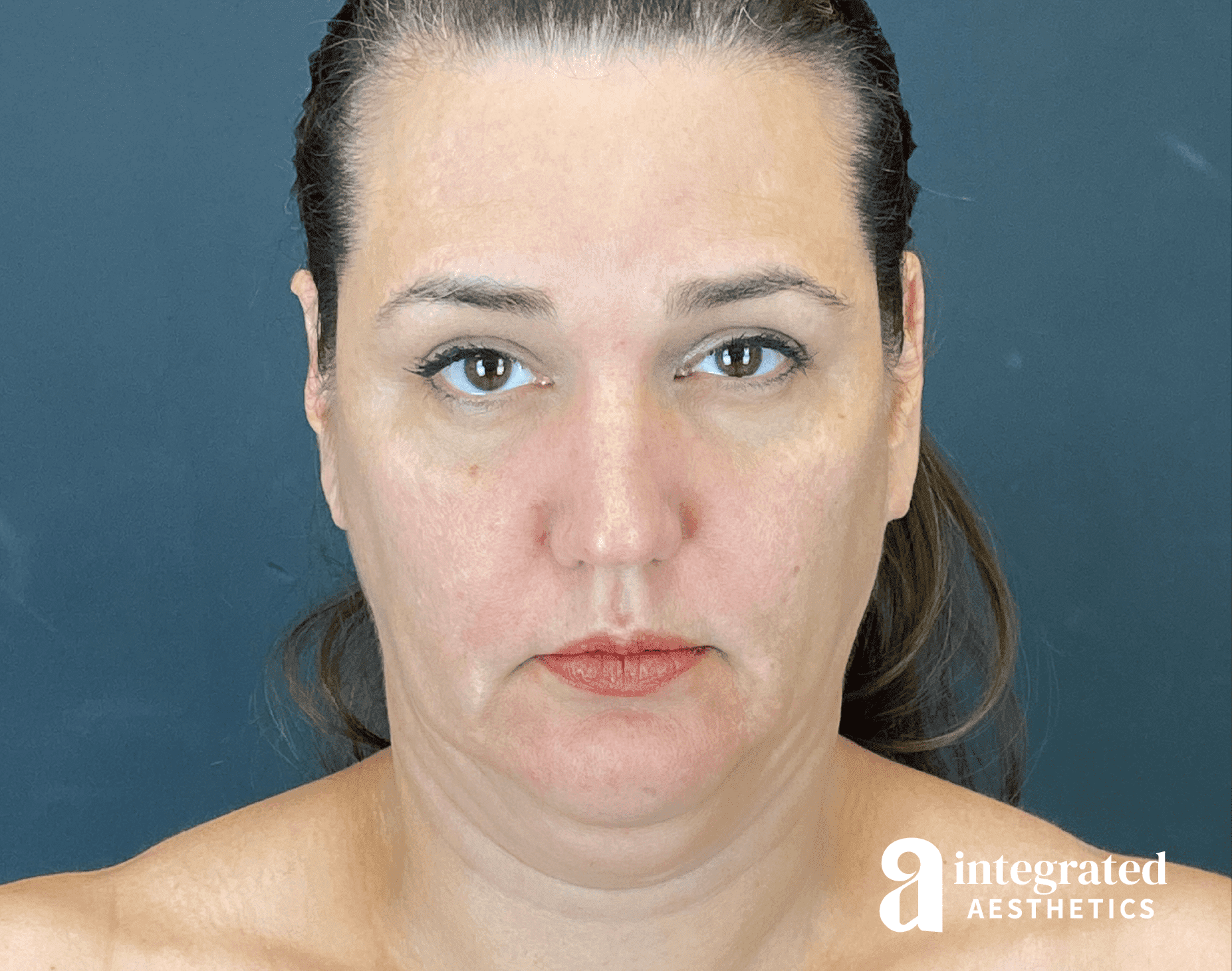 Facelift & Neck Lift Before & After Gallery - Patient 614844 - Image 1