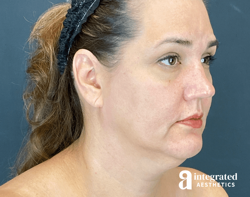 Facelift & Neck Lift Before & After Gallery - Patient 614844 - Image 3